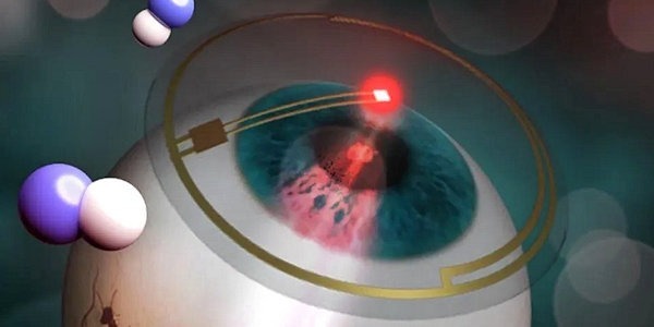 Lentilles du futur : une nouvelle option thérapeutique pour le diabète ?