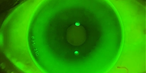 TIEDRA présente la lentille Alexa ES 12.70mm, lentille de contact rigide semi-sclérale